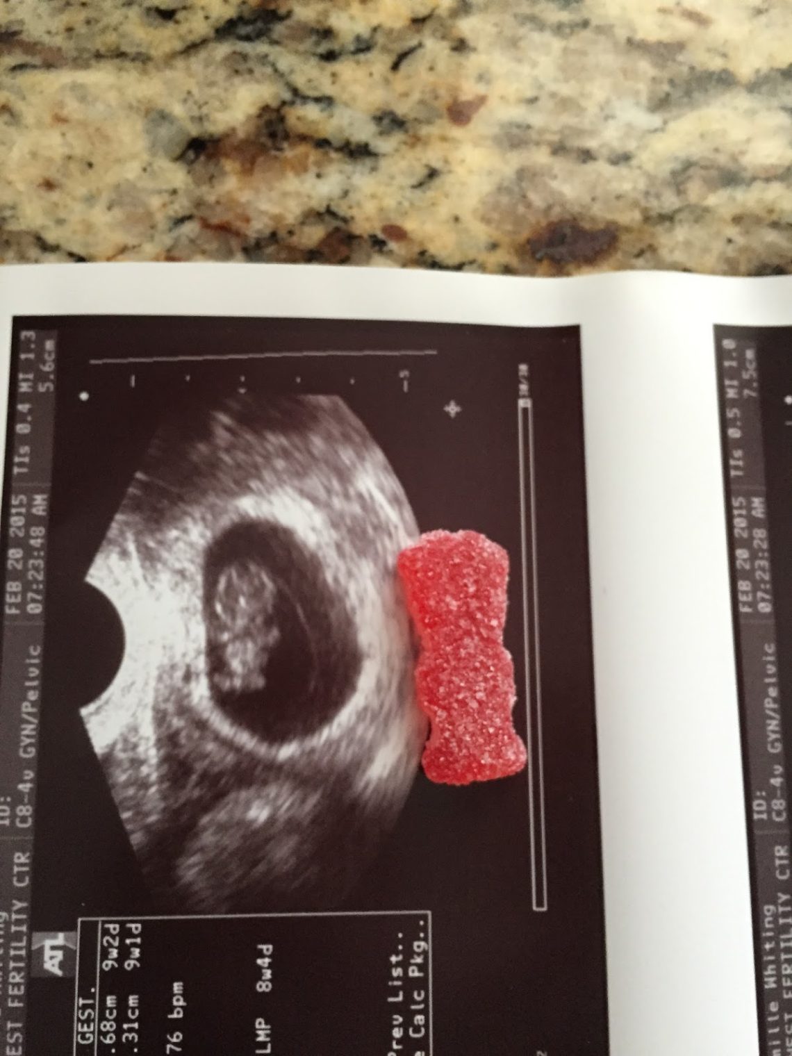 Ultrasound picture with a Sour Patch kid comparison. 